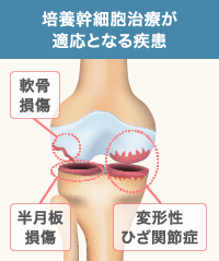 培養幹細胞治療はひざ関節内の疾患に効果的