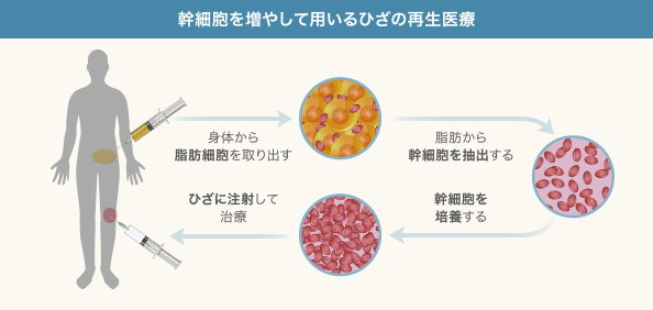 ひざの再生医療「培養幹細胞治療」の工程