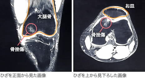 20代・男性／骨挫傷