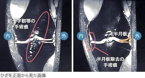 20代・男性/変形性膝関節症