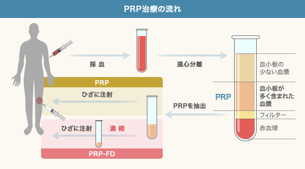 PRP（多血小板血漿）による治療の流れ