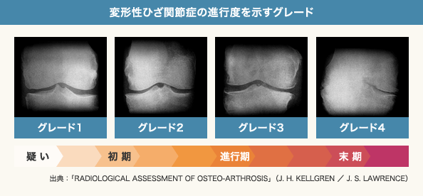 変形性ひざ関節症の進行度を示すグレード