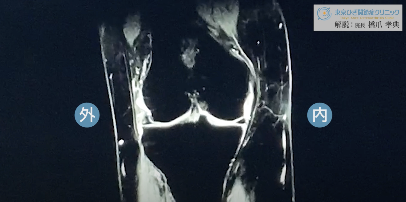 膝MRI画像（50代女性／中期変形性膝関節症）