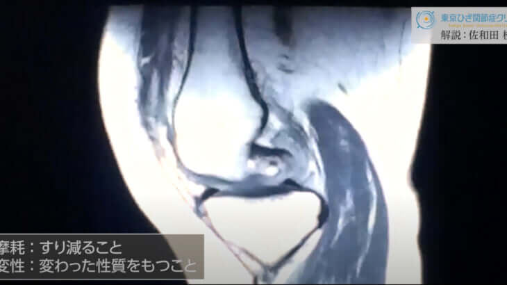 半月板断裂と誤診しないために知っておくべき3つの偽病変
